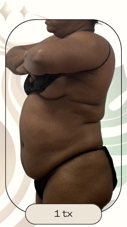 After — Accent Prime US/RF Abdomen
