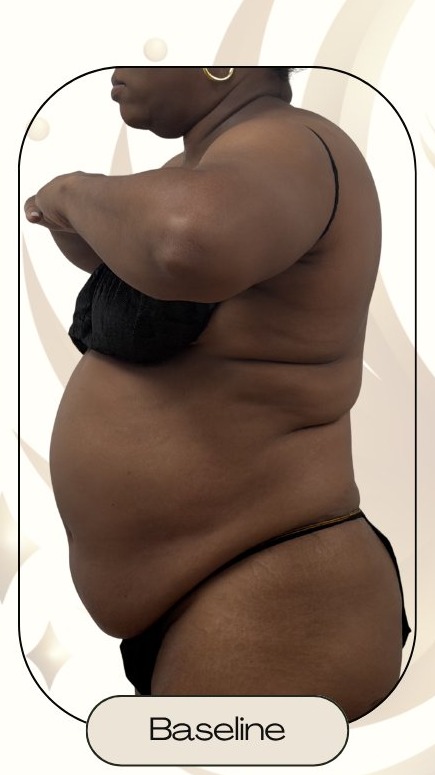 Before — Accent Prime US/RF Abdomen