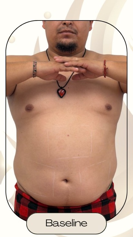 Before — Accent Prime US/RF Full Abdomen and Flanks