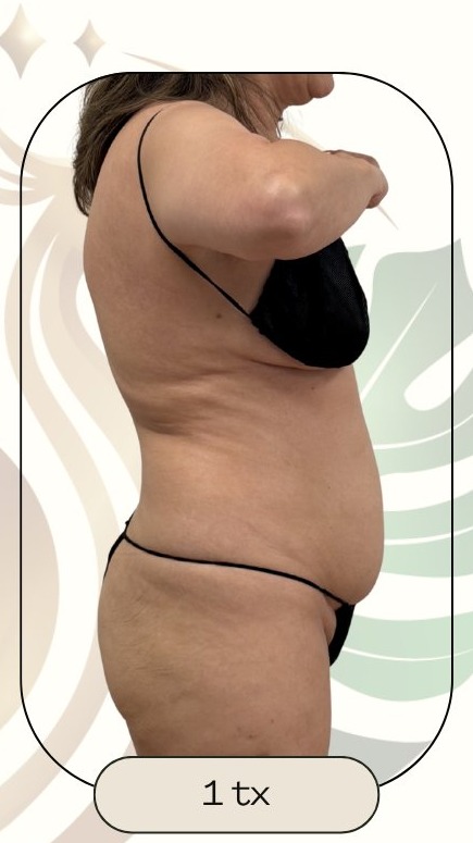 After — Rapid Results Treatment Lower Abdomen