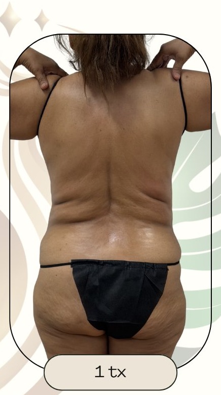 After — Accent Prime US/RF Lower Back