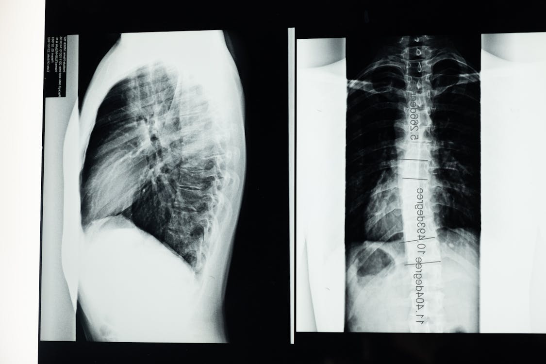 How Spinal Decompression Helps Herniated and Bulging Discs