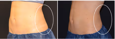 laser hair removal before and after