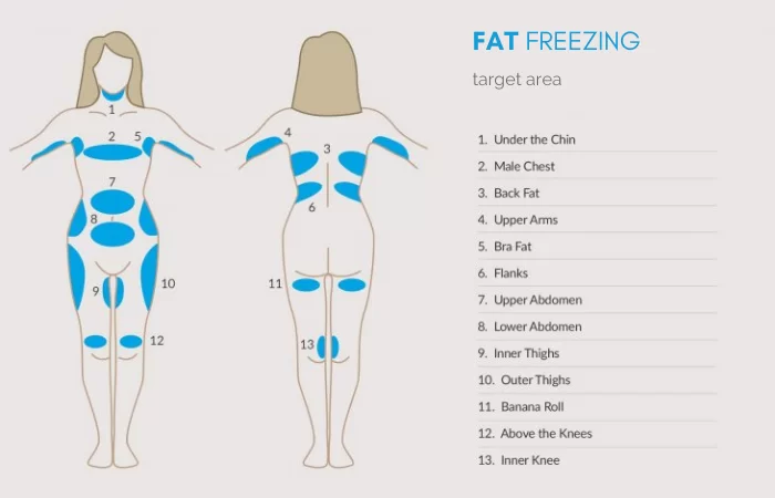 fat freezing treatment