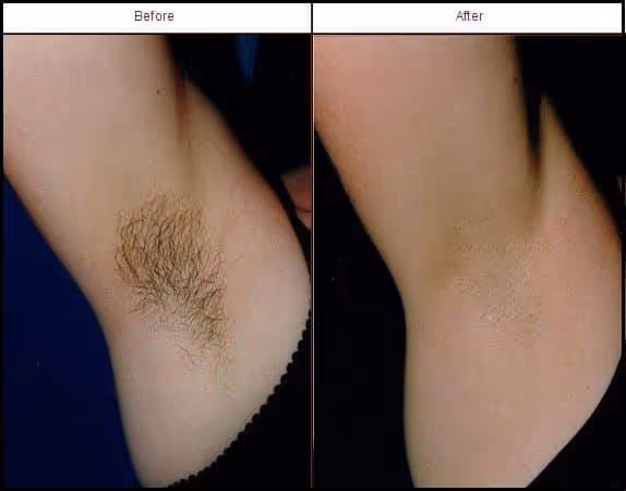 laser hair removal before and after