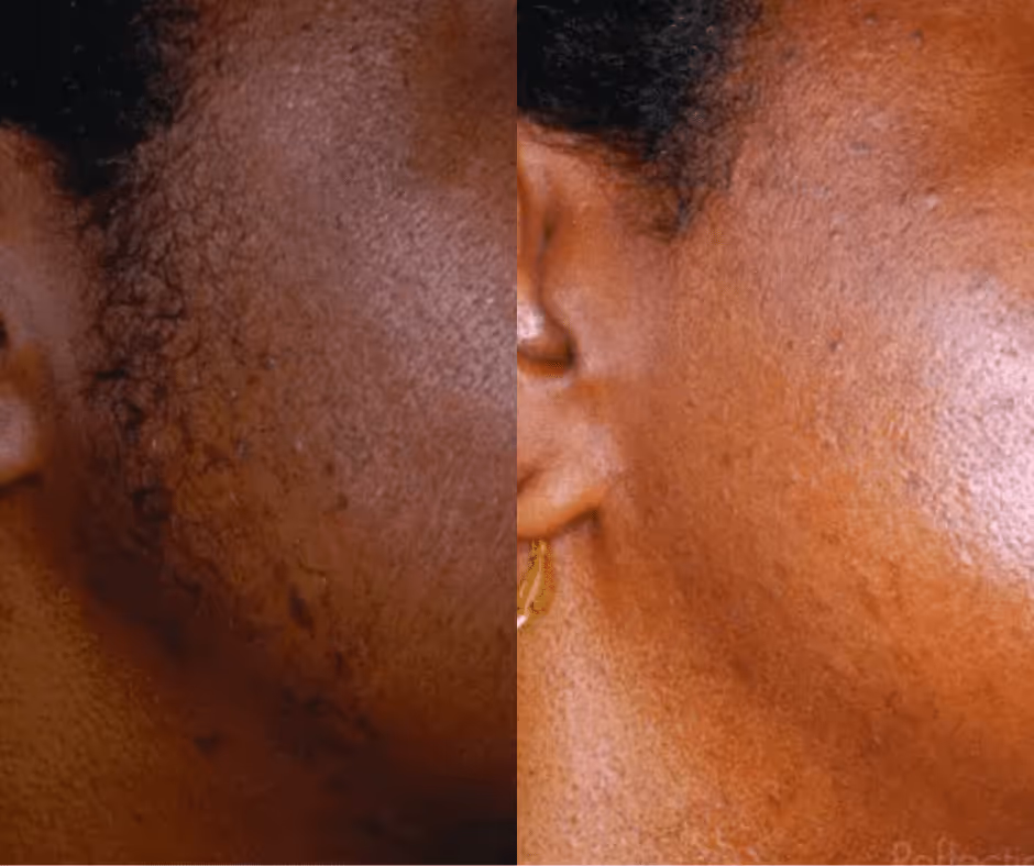 face laser hair removal