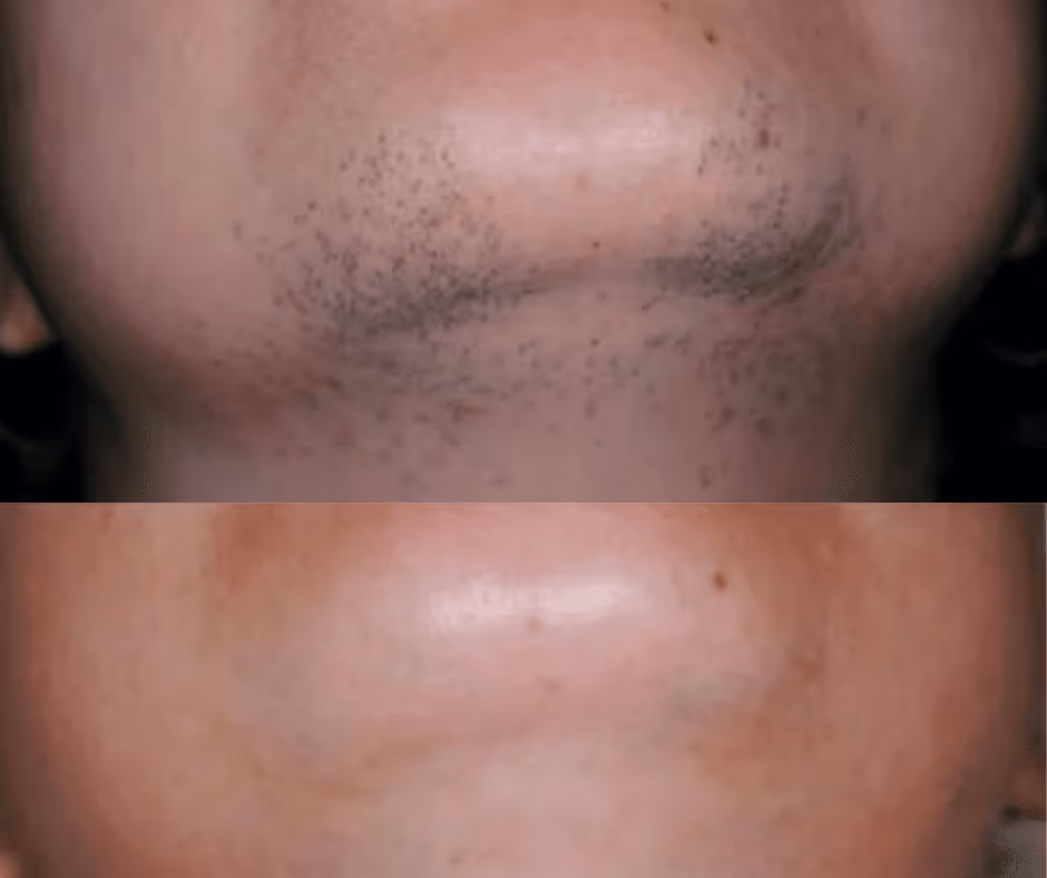 chin laser hair removal