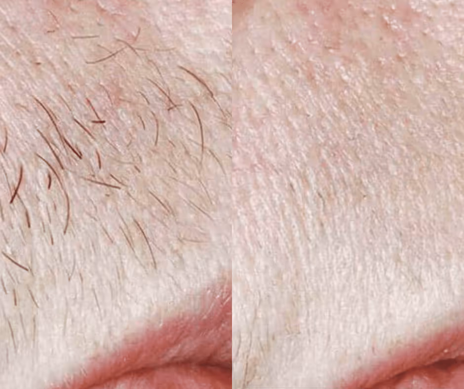 upper lip laser hair removal