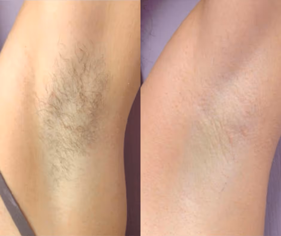 underarm laser hair removal