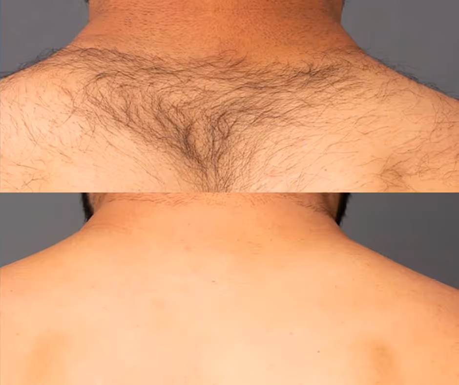 back laser hair removal