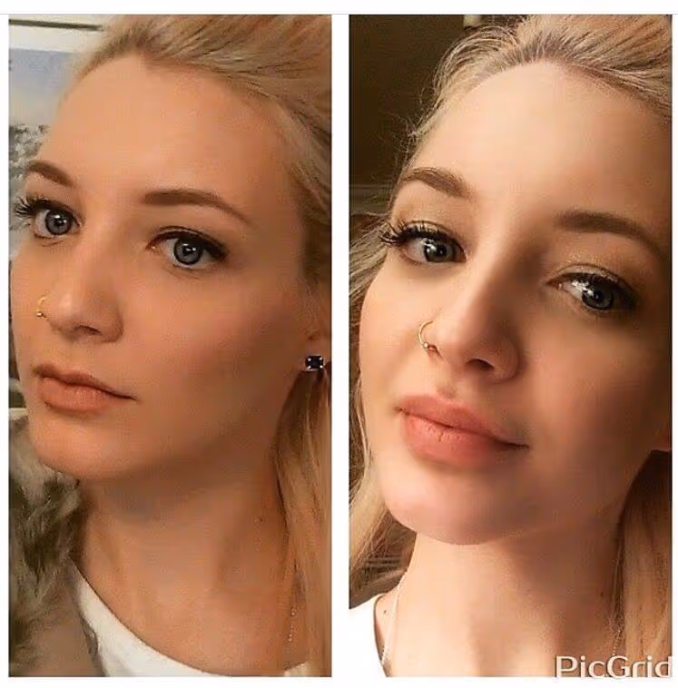 dermal filler before and after
