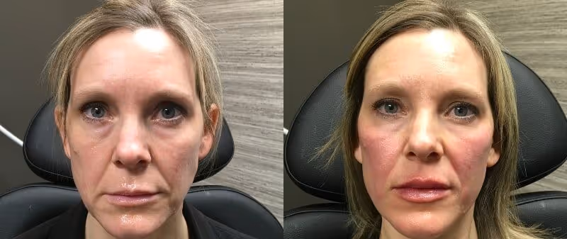 dermal filler cheek