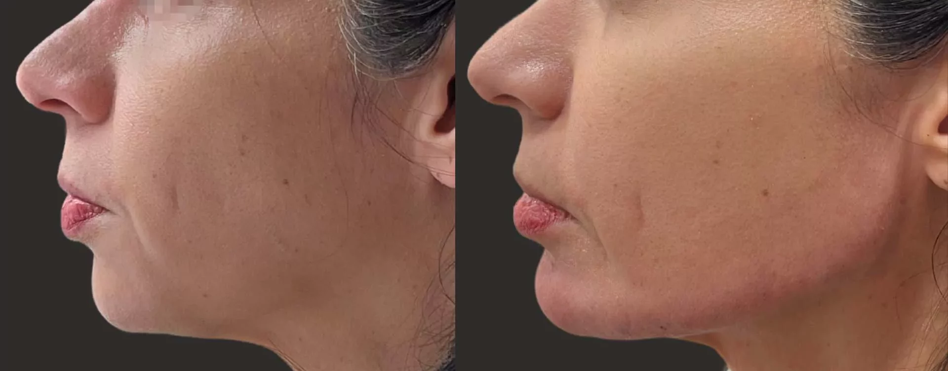 dermal filler jawline