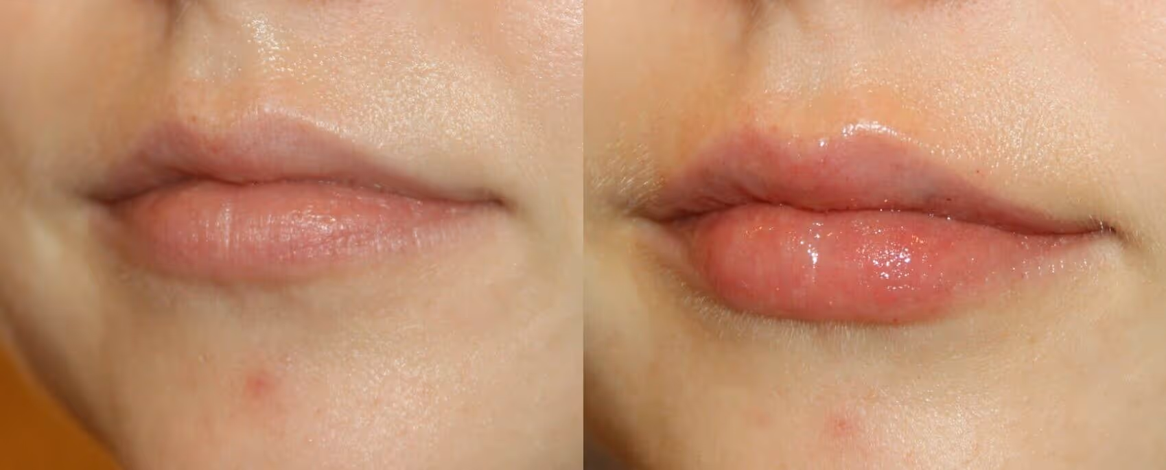 dermal filler lip
