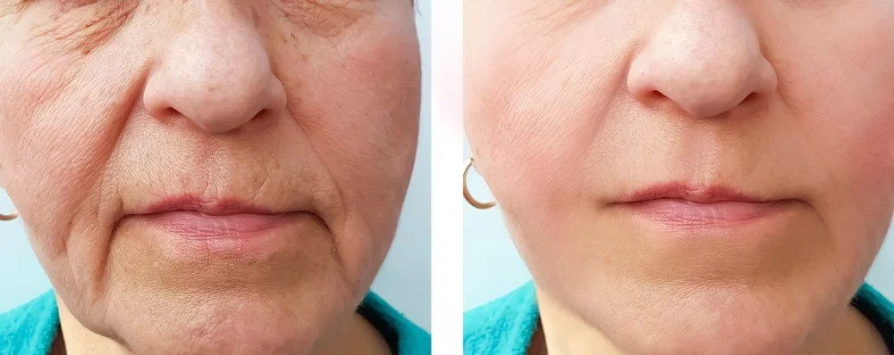 dermal filler marionette lines