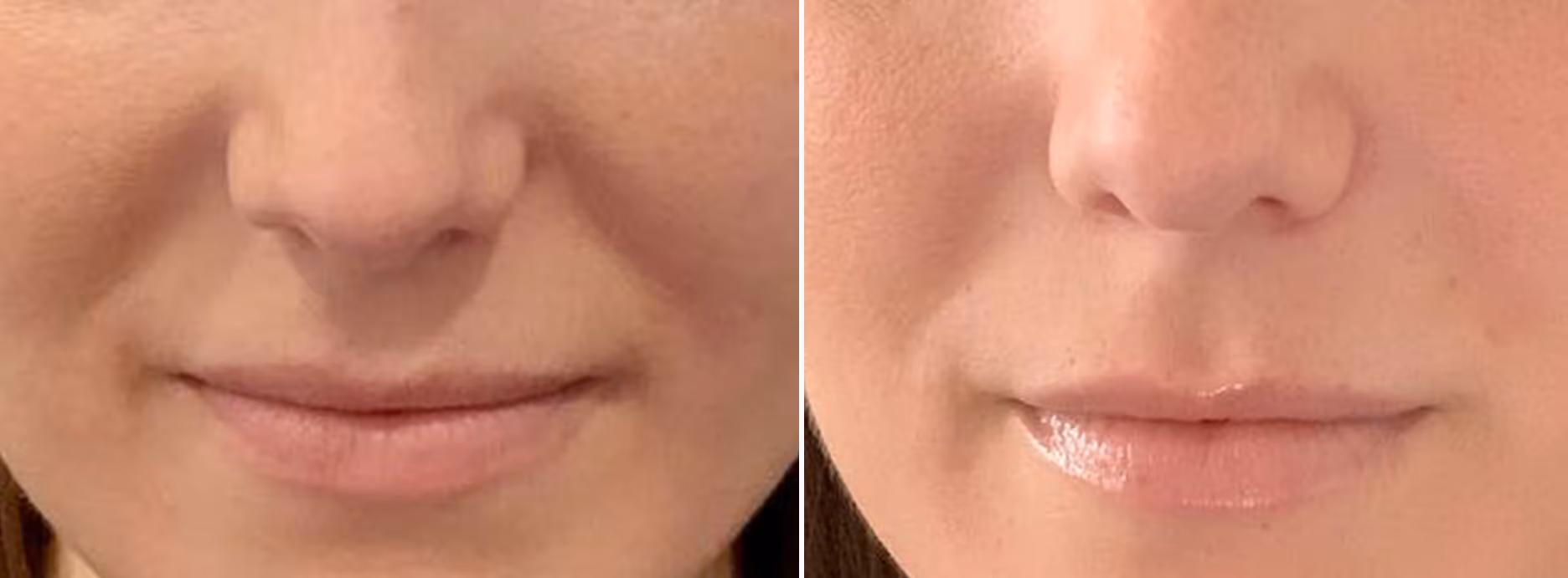 dermal filler nose
