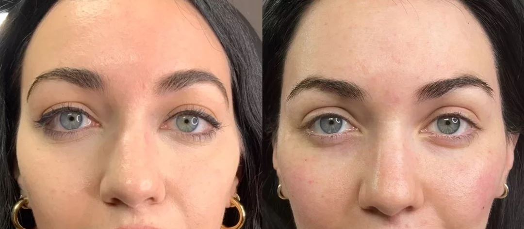 dermal filler temple