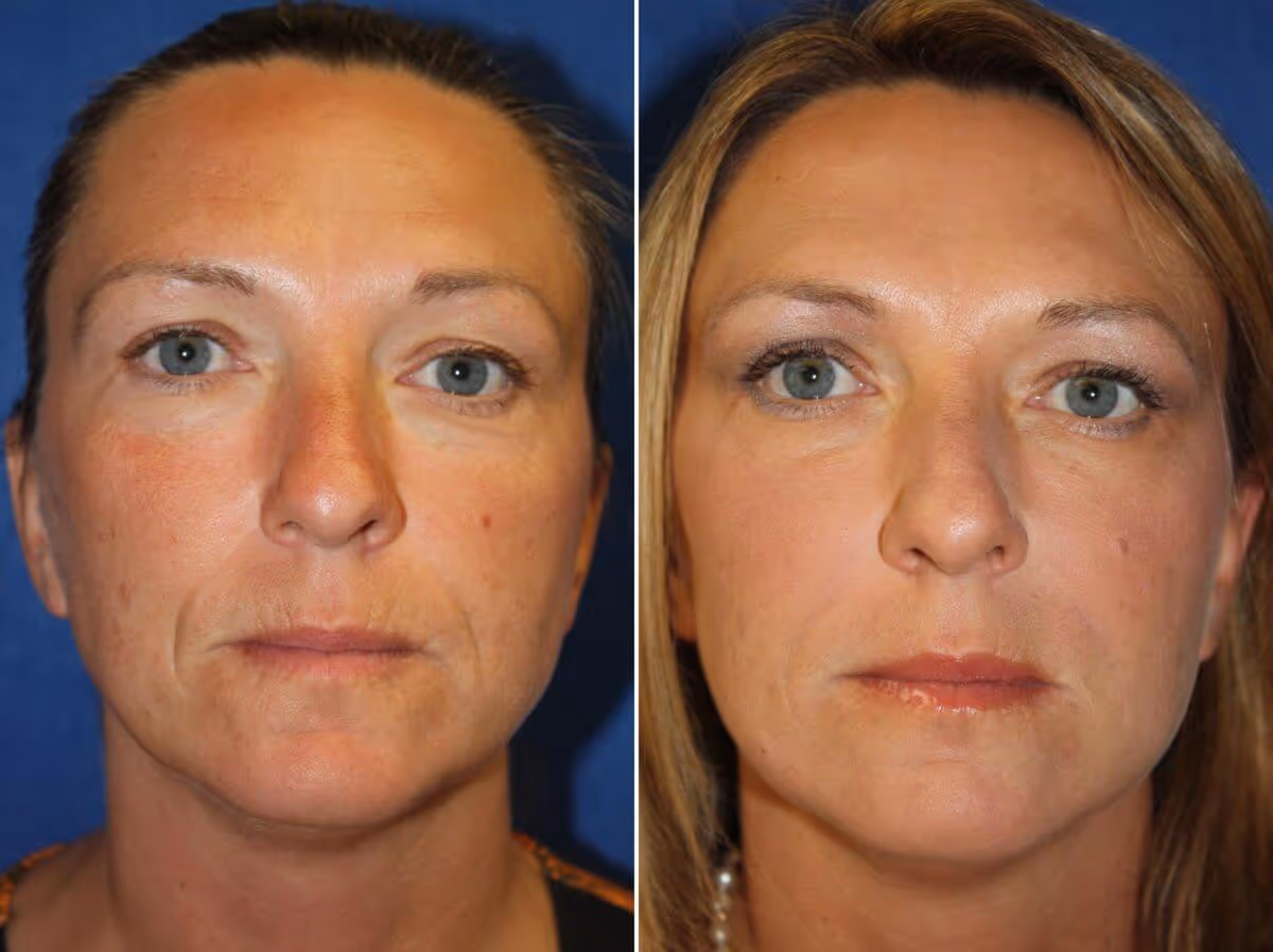 dermal filler before and after