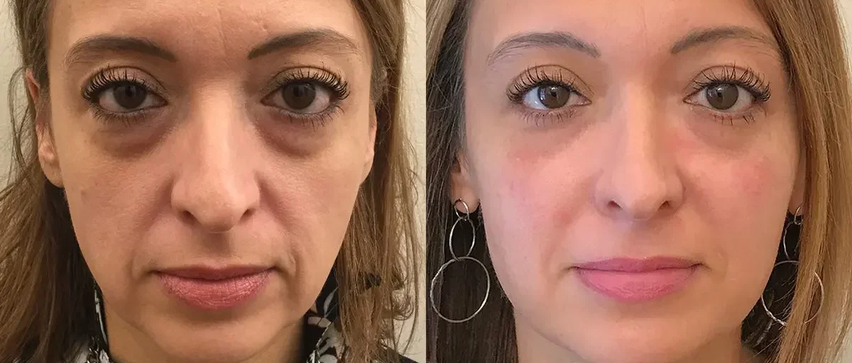 dermal filler under eye