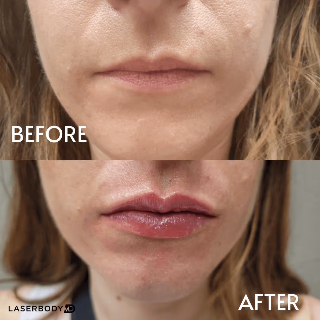 dermal filler before and after