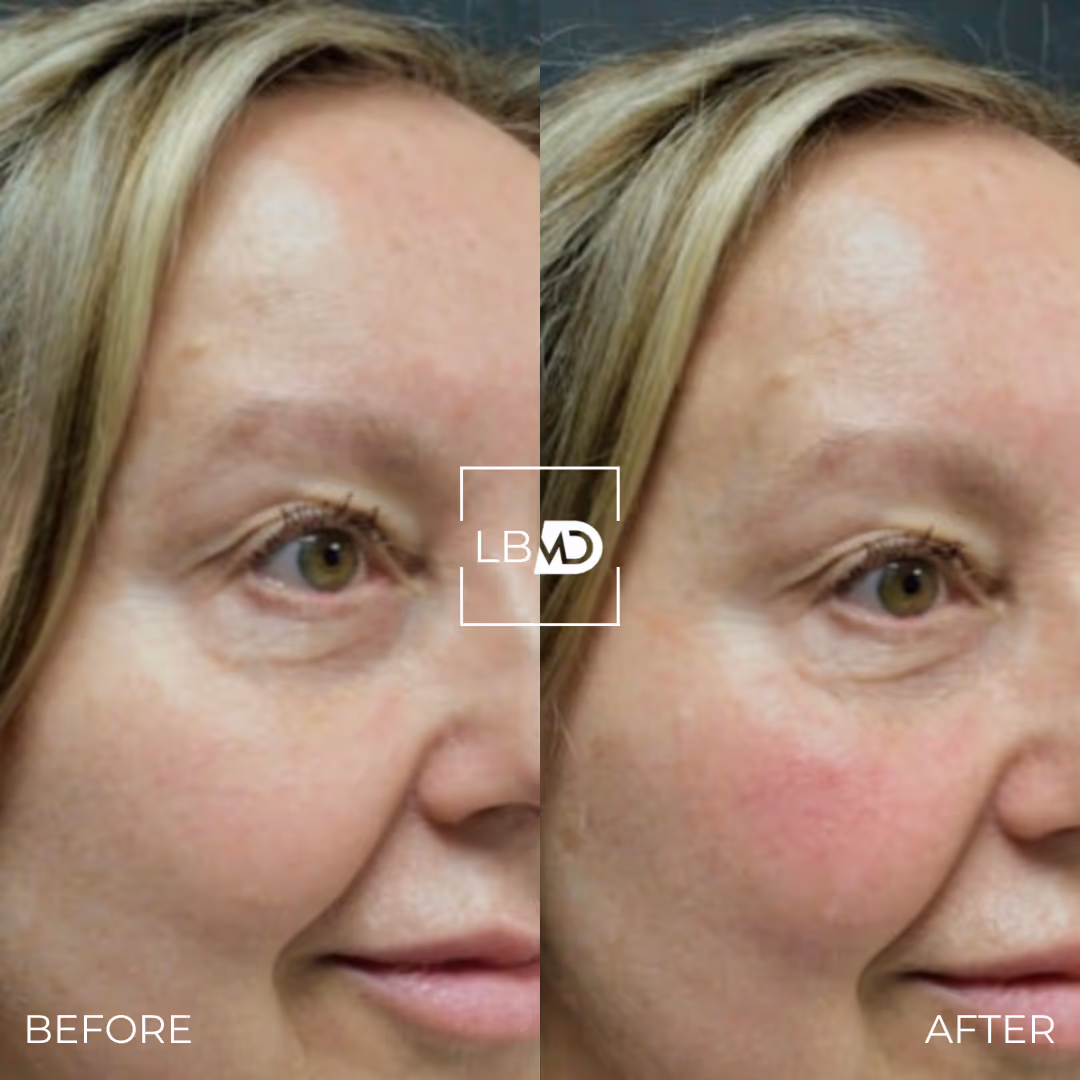 laser hair removal before and after