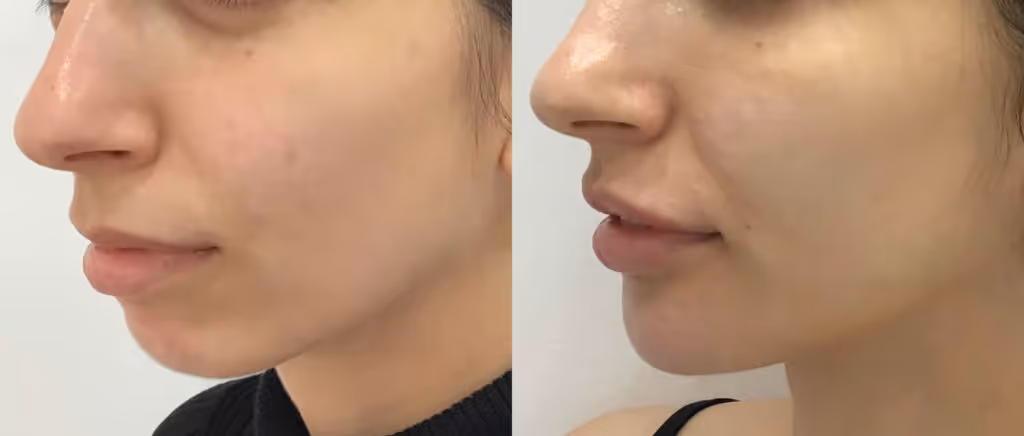 dermal filler chin