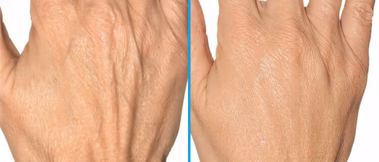 hand dermal filler before and after