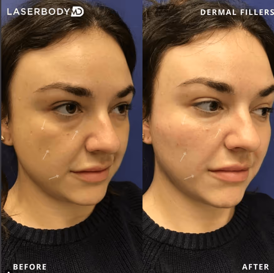 dermal filler before and after