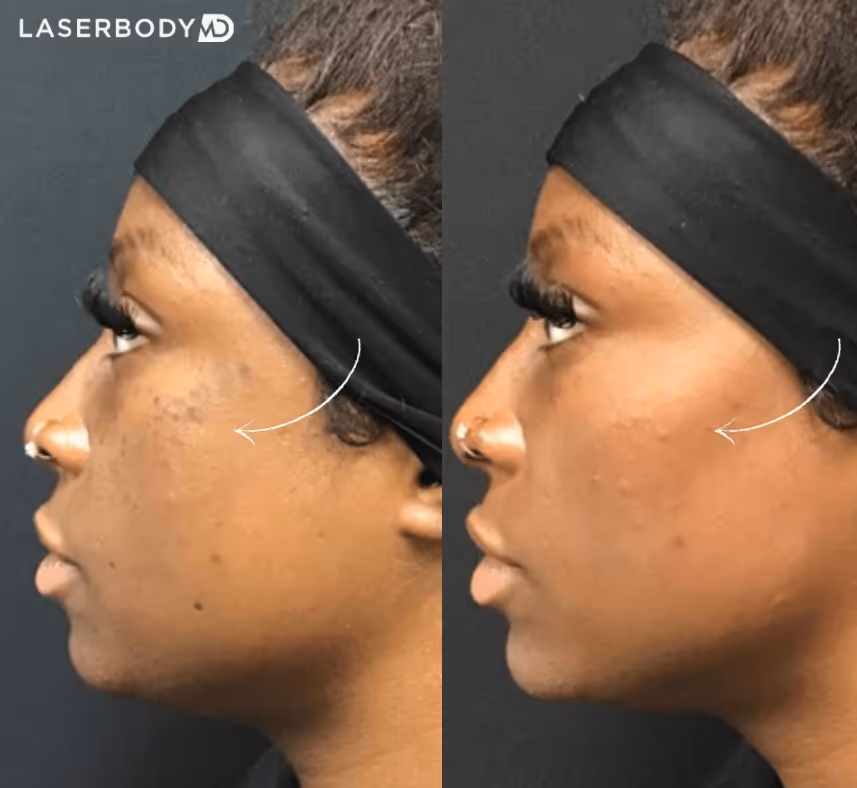 dermal filler before and after
