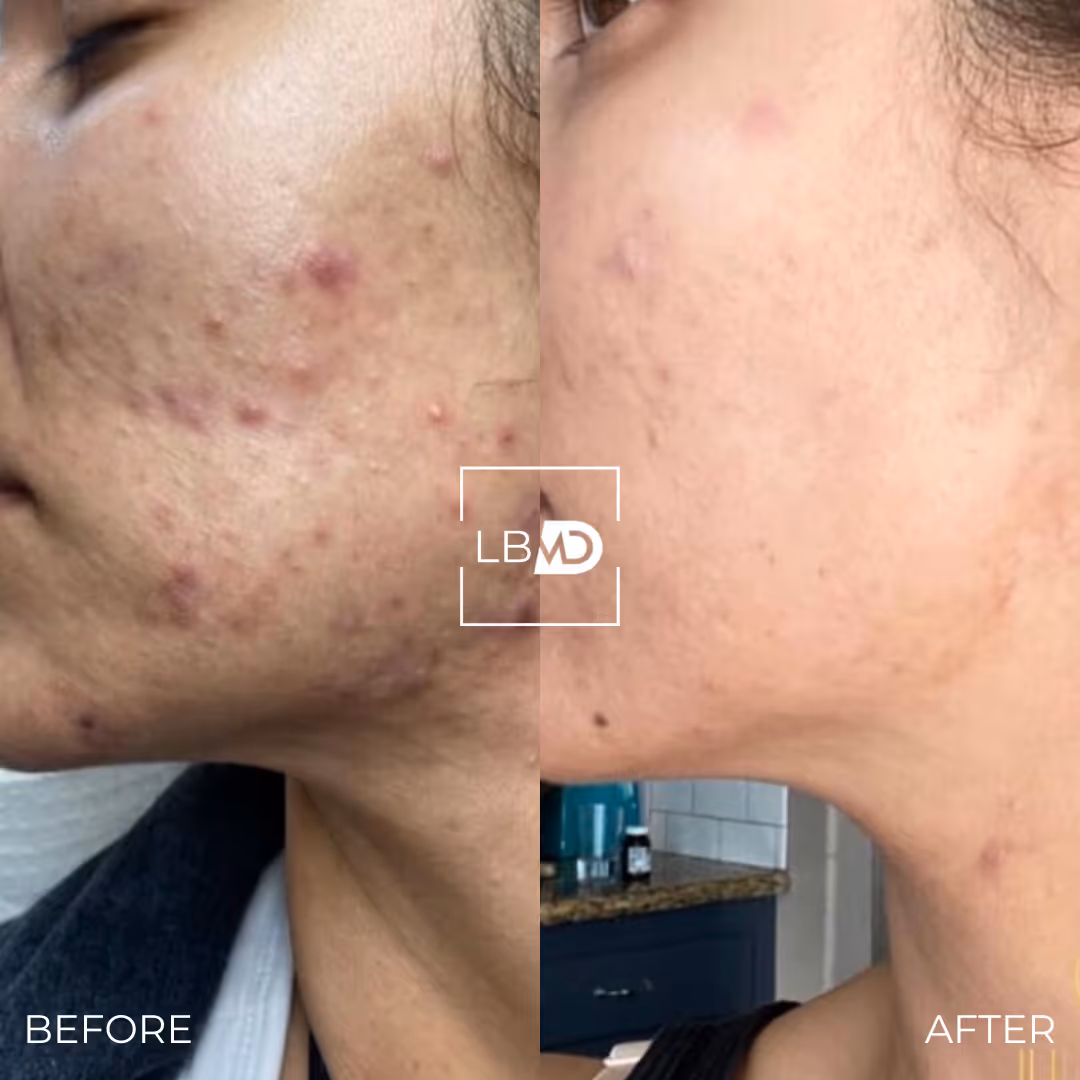 morpheus8 before and after