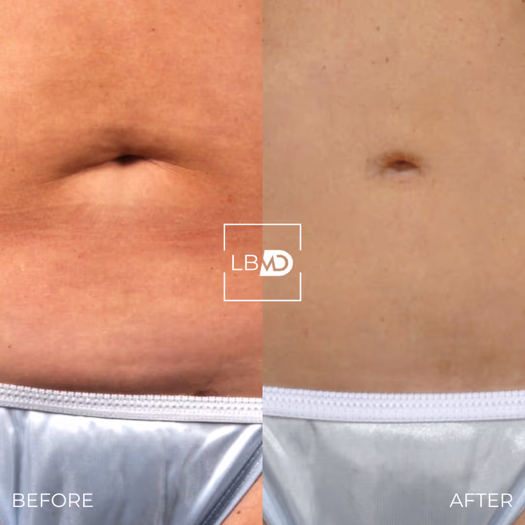 laser hair removal before and after