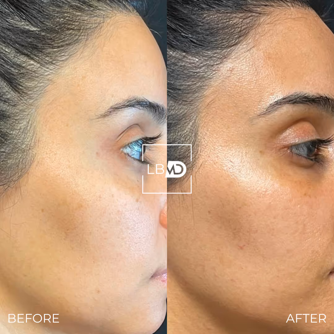 laser hair removal before and after