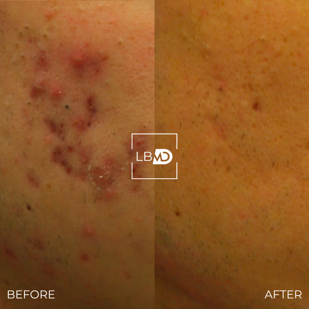 laser hair removal before and after