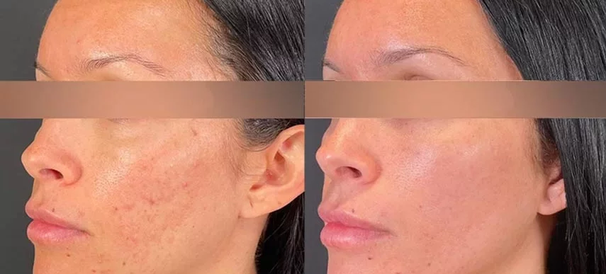 morpheus8 before and after