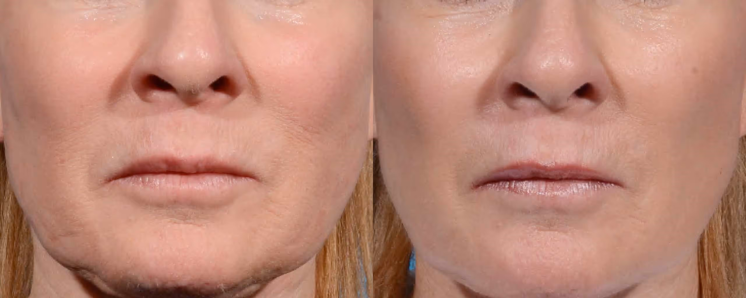 face morpheus8