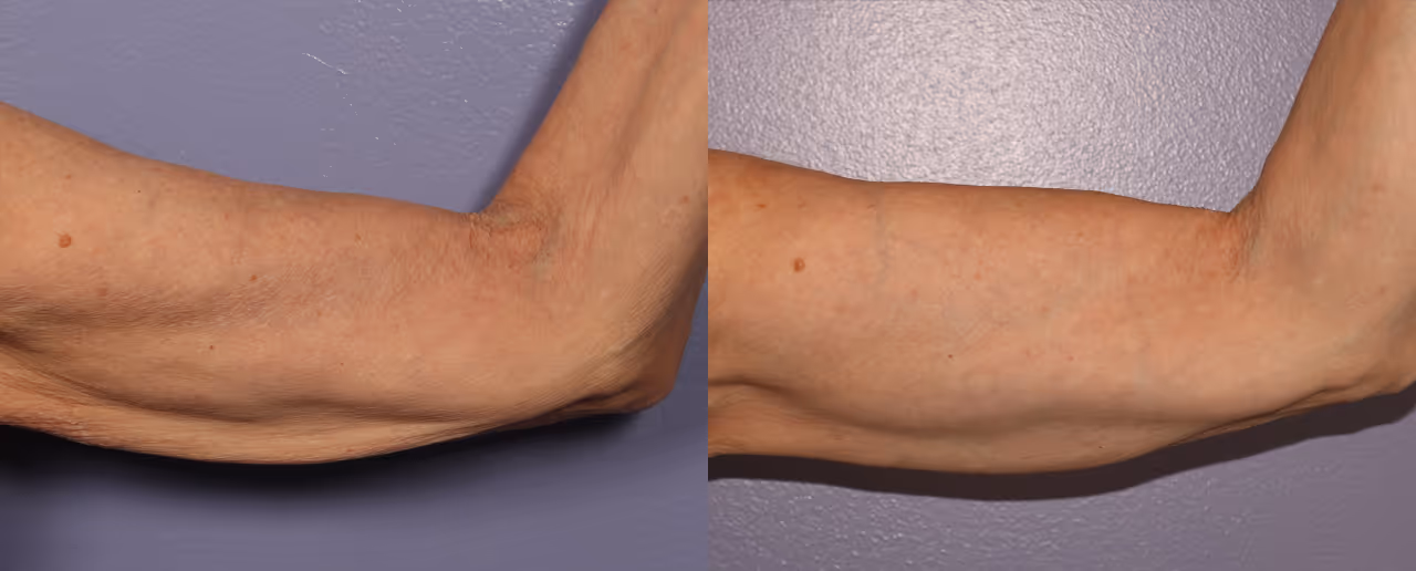 arms morpheus8