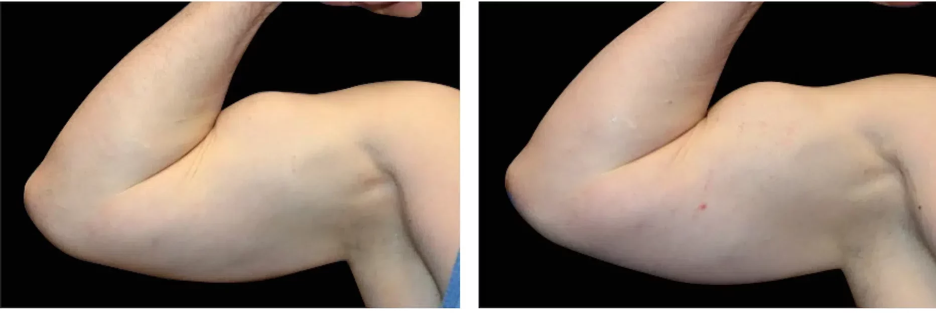 emsculpt arms