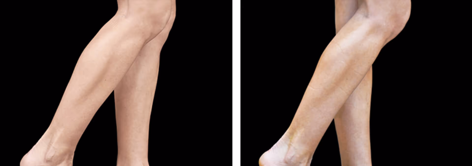 emsculpt calves