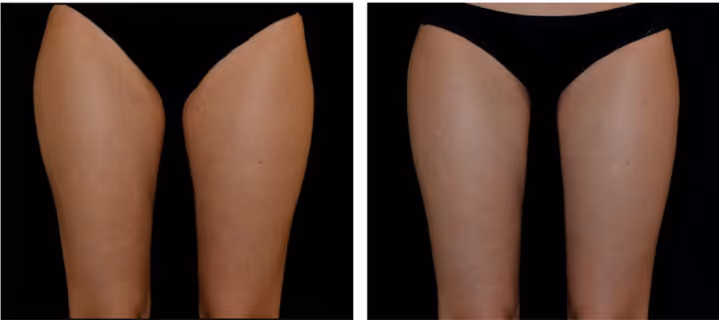 emsculpt thighs