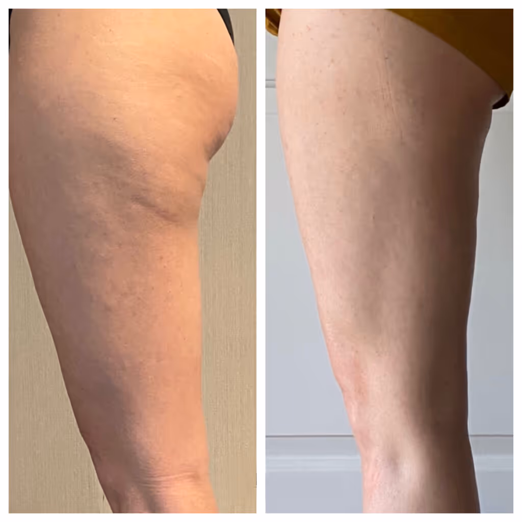 botox before after