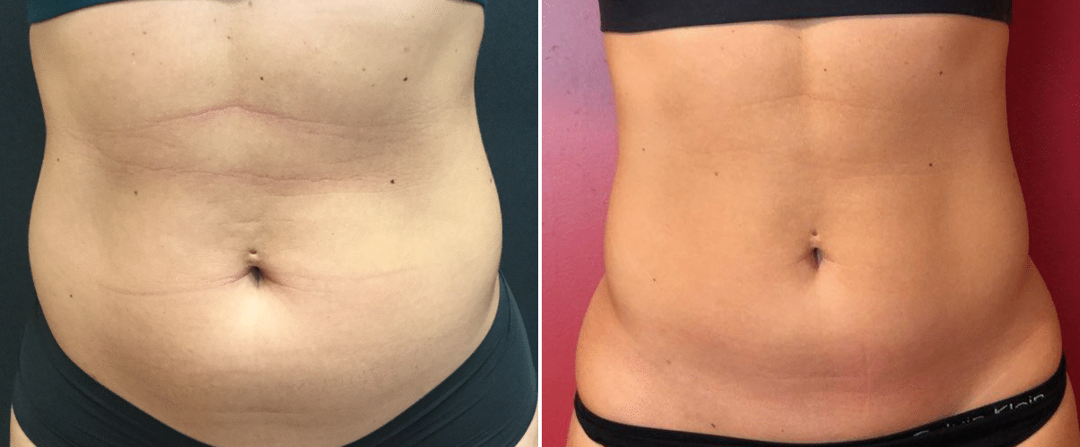 coolsculpting before and after