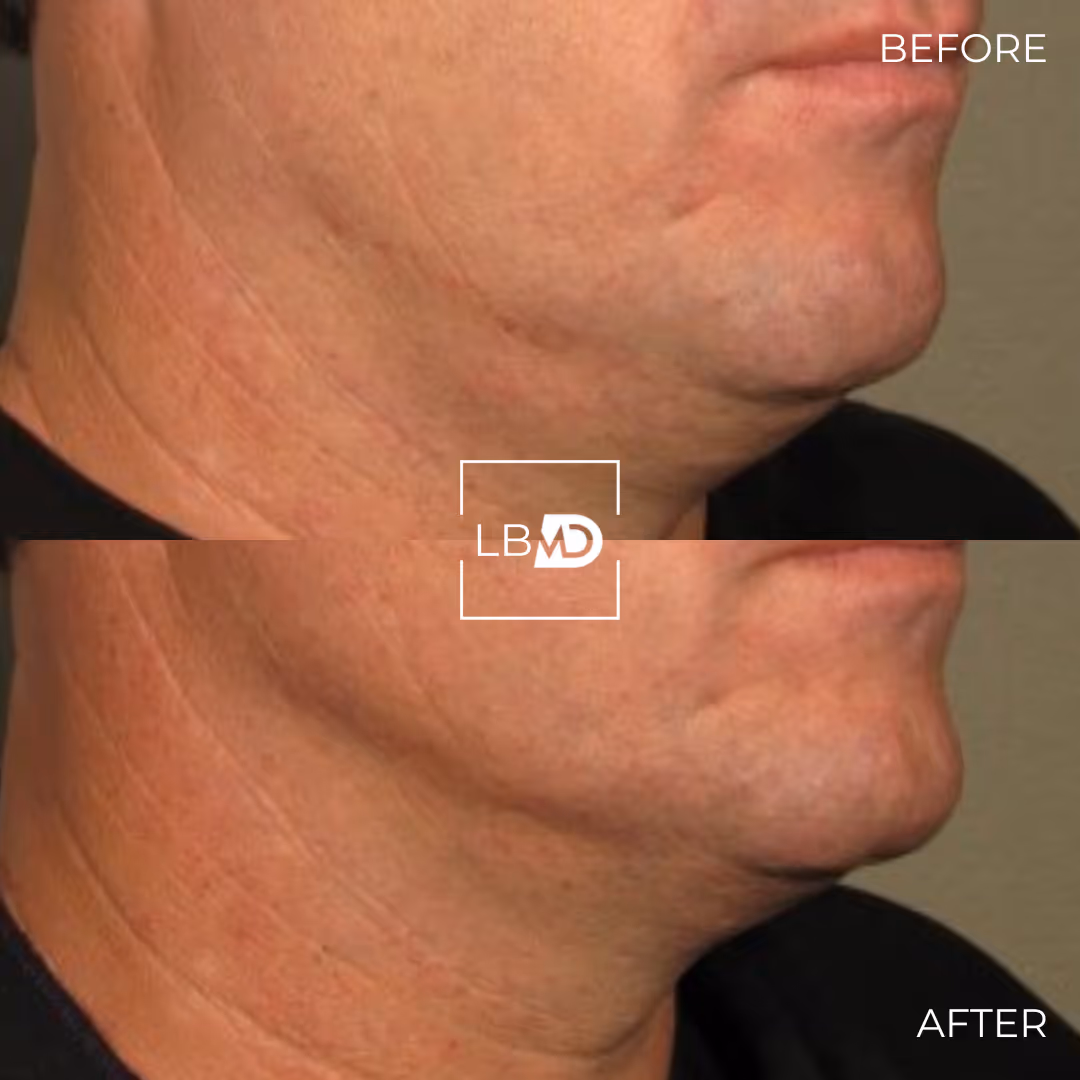 Beffore abd afterr botox treatment