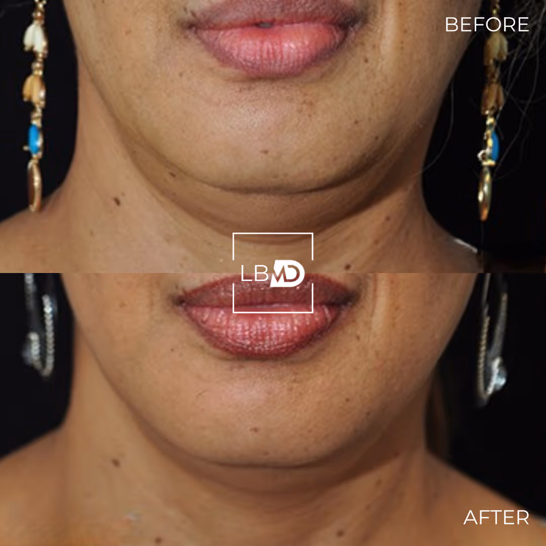 Before and after botox