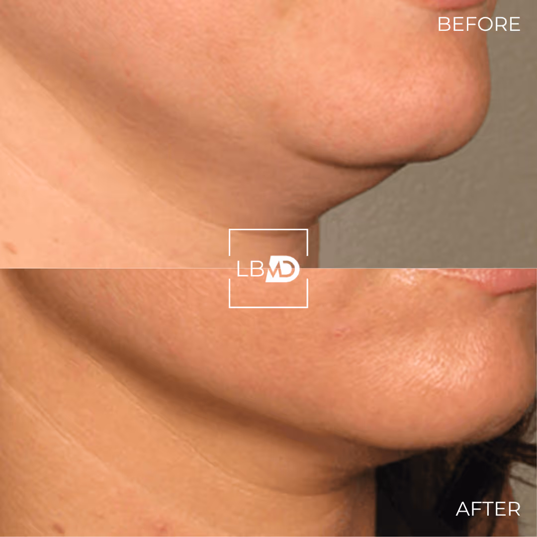 Botox before after