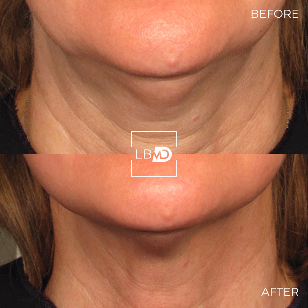 botox before after
