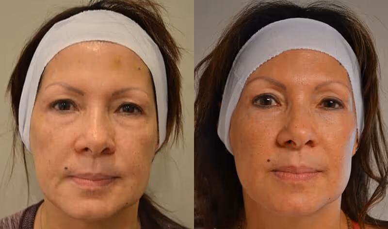 ultherapy for face
