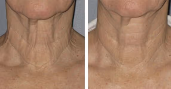 ultherapy for neck