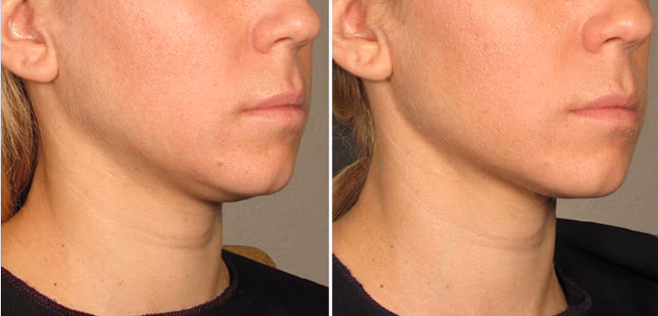 ultherapy for chin