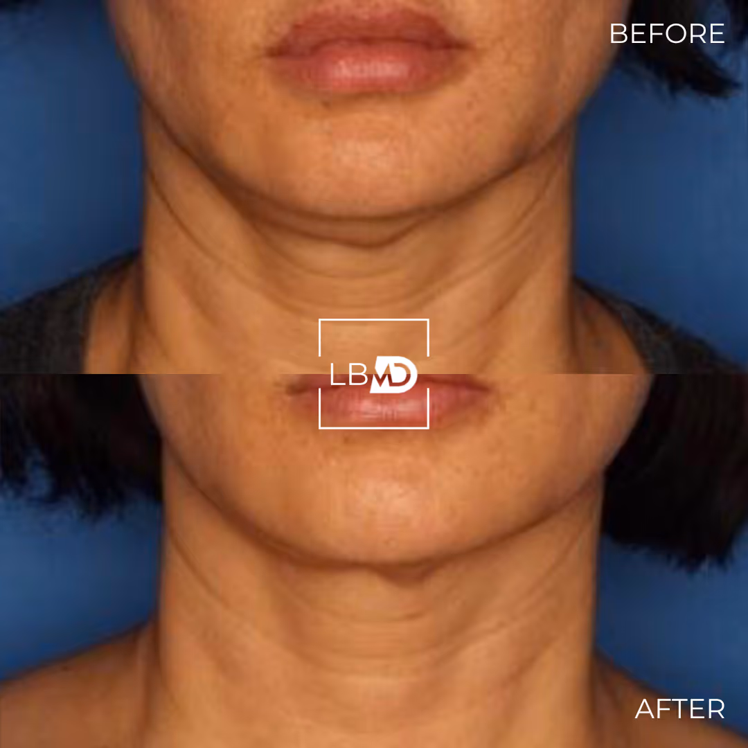 Botox before afterr