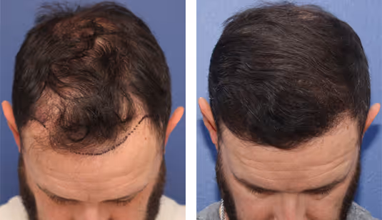 hair transplant before and after